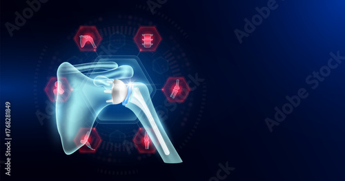 Shoulder replacement surrounded by arthritis icons. Artificial joint surgery, prosthetic implant integrated into the bone. Orthopedic technology medical. Empty space for text. Vector EPS10.