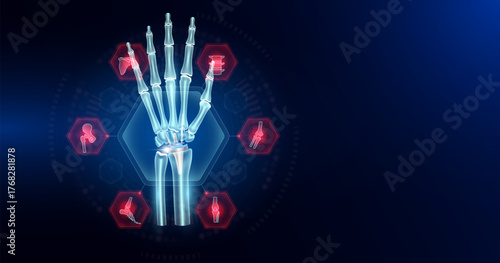 Wrist replacement partial surrounded by arthritis icons. Artificial joint surgery, prosthetic implant integrated into the hand bone. Orthopedic technology medical. Empty space for text. Vector.