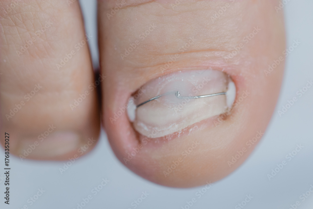 Fototapeta premium Closeup ingrown toenail after Restoration of with titanium bracket nail shape, medical podiatrist treatment