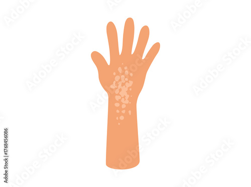 Fungal Tinea Versicolor Illustration