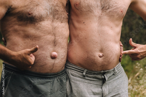 Photograph, portrait of a family of adult men, two people, father and son, with umbilical hernias inherited. Concept of illness.