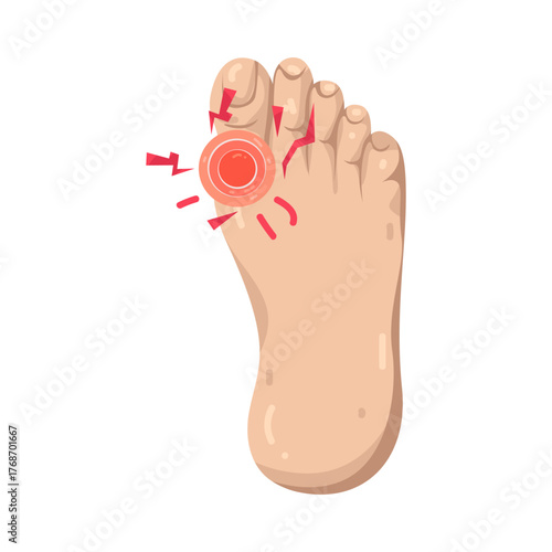 Illustration of Foot with Gout Pain