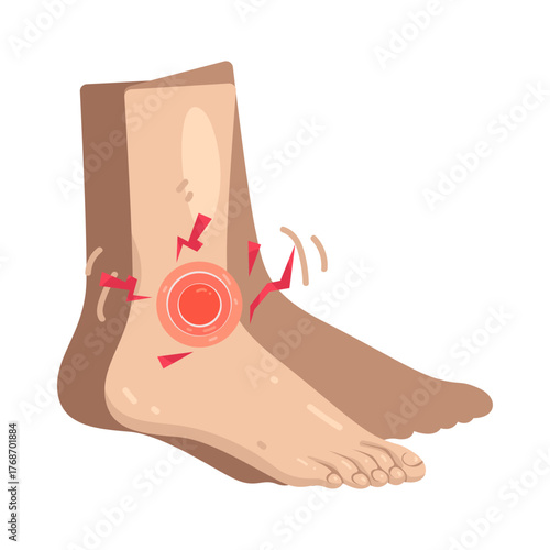 Illustration of Sprained Ankle with Pain