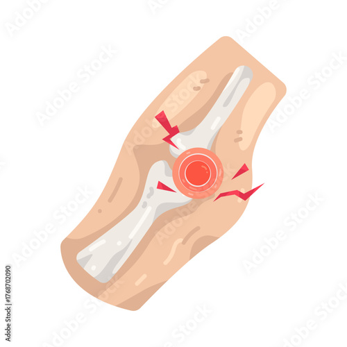 Illustration of Elbow Fracture with Inflammation