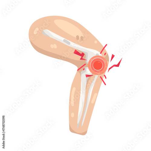 Illustration of Knee Joint Pain