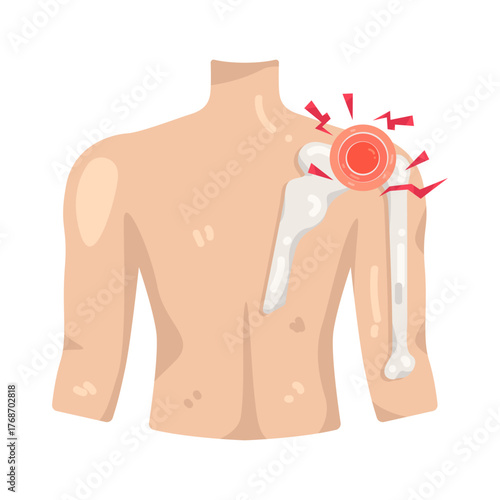 Illustration of Shoulder Joint Pain