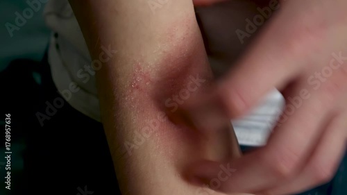 Atopic dermatitis on a child's elbow crease, scratching irritated and itchy red skin