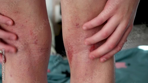 Child with atopic dermatitis scratching irritated and sore skin behind the knee