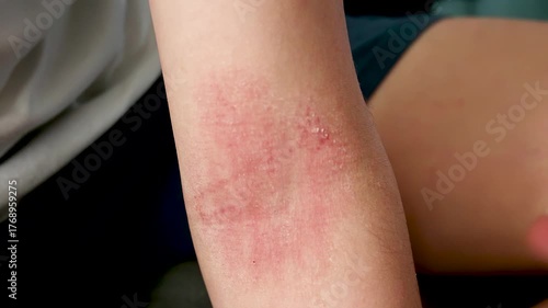 Applying healing cream to the skin on the elbow crease with atopic dermatitis