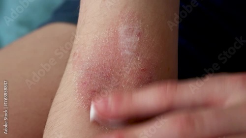 Applying healing cream to irritated skin on a child's elbow crease with atopic dermatitis. Treatment with clean hands