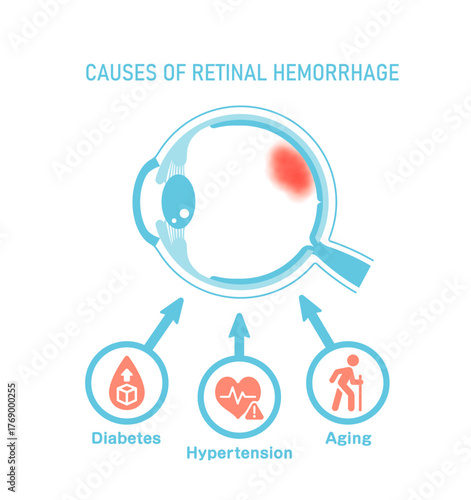Causes of retinal hemorrhage. Vector illustration.