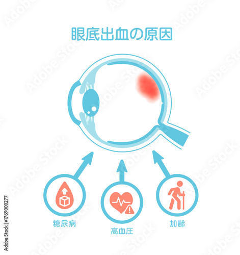 眼底出血の原因 ベクターイラスト