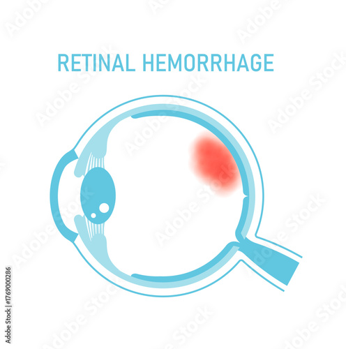 Vector illustration of retinal hemorrhage