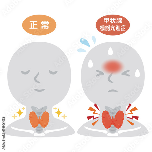 働きが過剰になっている甲状腺のと元気な甲状腺の人物イラスト／Comparison of Healthy and Overactive Thyroid Glands on Human Silhouette