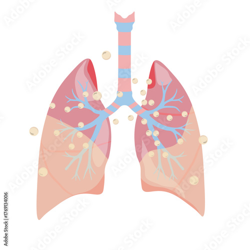 Pneumonia Illustration