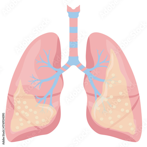 Pneumonia Illustration