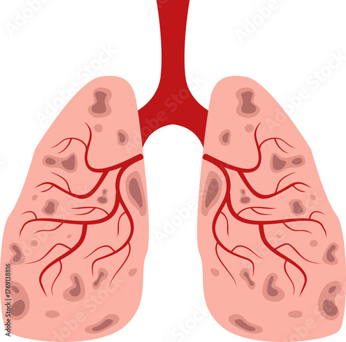 Pneumonia Illustration