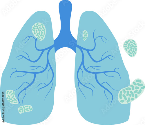 Pneumonia Illustration