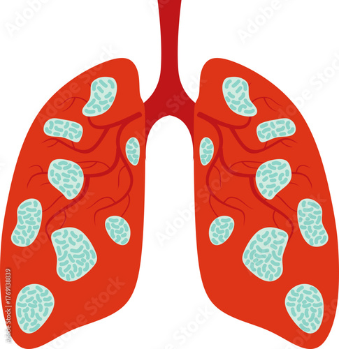 Pneumonia Illustration