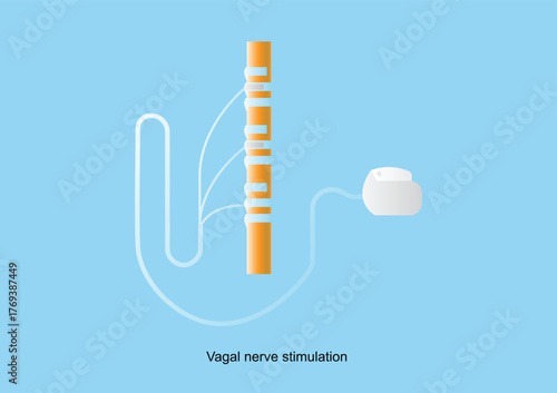 Vagal nerve stimulation (VNS). Neuromodulation device for treatment of epilepsy