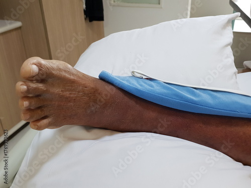 Purpura caused by cancer on leg is side effect of chemotherapy or caused by cancer cells interfering with platelet production in the bone marrow.