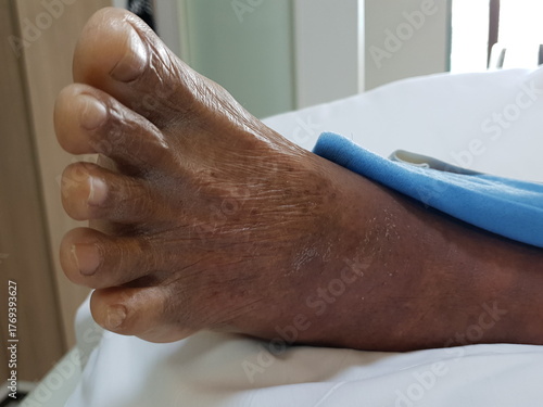 Purpura caused by cancer on leg is side effect of chemotherapy or caused by cancer cells interfering with platelet production in the bone marrow.