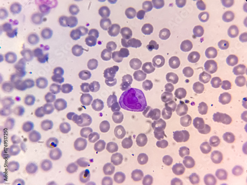 Leukemia cells, Neutrophil , Lymphocyte in blood smear.