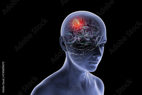 Brain tumor, 3D illustration