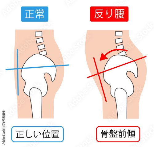 反り腰の骨盤前傾と正常な骨盤の位置