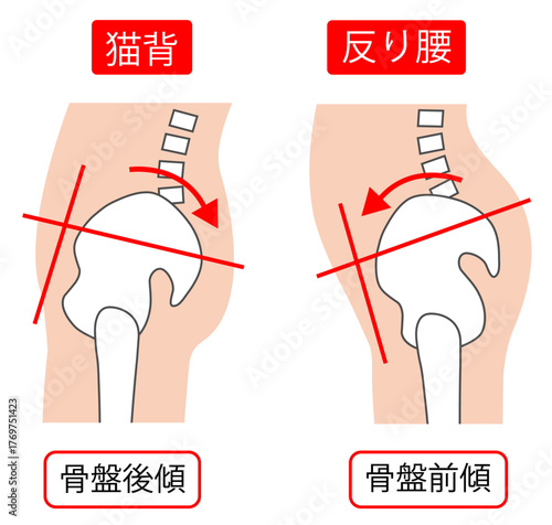 猫背の骨盤後傾と反り腰の骨盤前傾