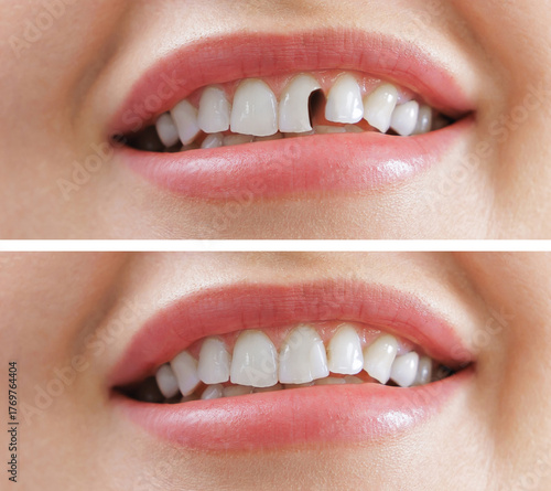 Fényképezés Female dental transformation: before and after correction restoration of chipped
