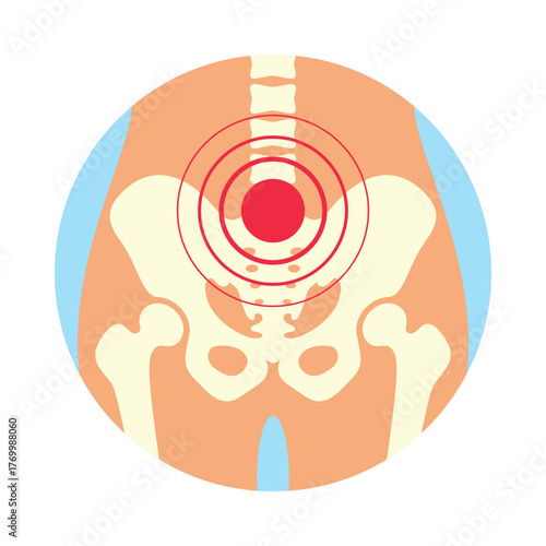 A pelvis with highlighted areas indicating pain, fracture, or inflammation. It represents common issues related to pelvic health.