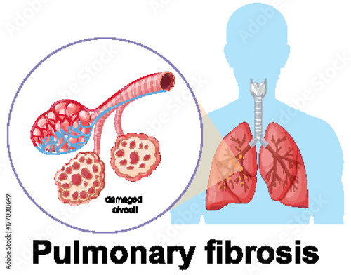 Pulmonary Fibrosis Lung Damage Medical Vector Illustration