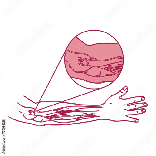 Forearm Muscle Injury