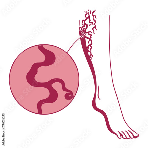 Varicose Vein Diagram