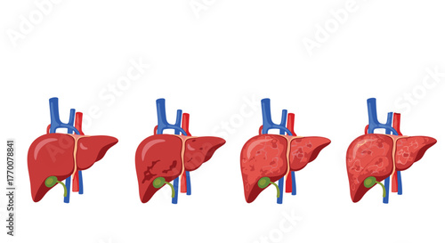 Progression of liver disease showing stages from a healthy liver to severe scarring and cirrhosis.