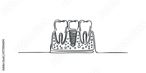 Dental implant structure showing tooth root and bone integration