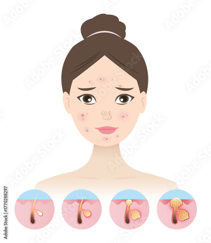 Inflammation acne process on woman face vector illustration on white background. Icon set of micro inflammation to visible inflammatory acne, papule, pustule, pimple on the skin inflamed, contain pus.