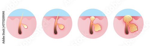 Inflammation acne process vector icon set illustration on white background. From micro inflammation to visible inflammatory acne, papule, pustule, blister or pimple on the skin inflamed, contain pus.