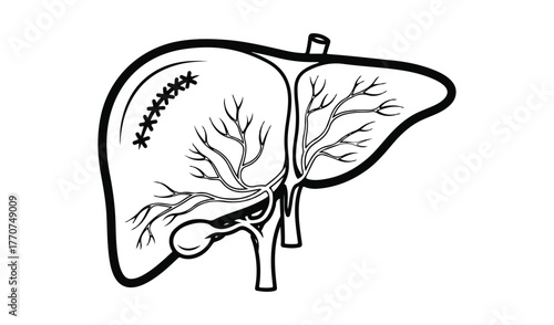 Illustration of a human liver with surgical sutures and blood vessels
