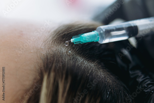 close up on woman head getting mesotherapy injections for stronger and healthier hair