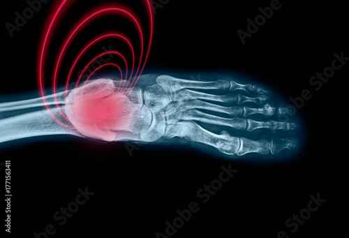 Foot pain on x-ray on black background