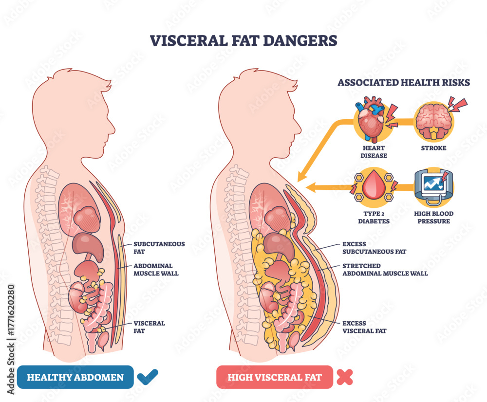 Obraz premium Visceral fat dangers compare healthy vs high-fat abdomens, showing organs, visceral fat around the belly, and risk icons for heart and brain. Outline diagram