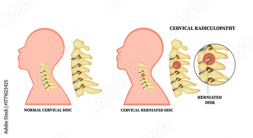 Herniation Bone Disk Neck Thoracic Outlet Syndrome Vector Illustration