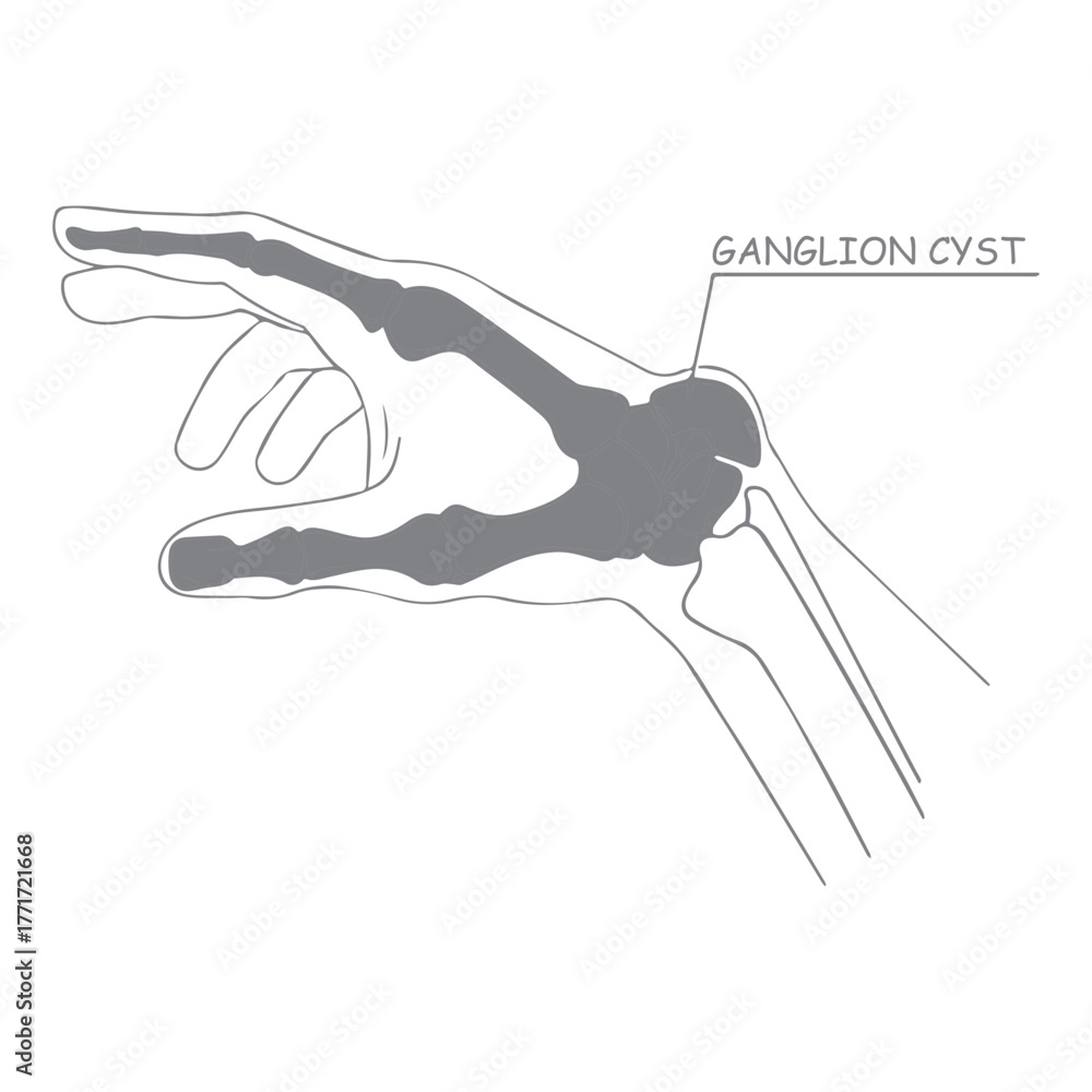 Obraz premium Ganglion Cyst Diagram
