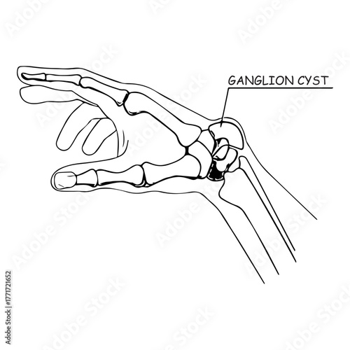 Ganglion Cyst Diagram
