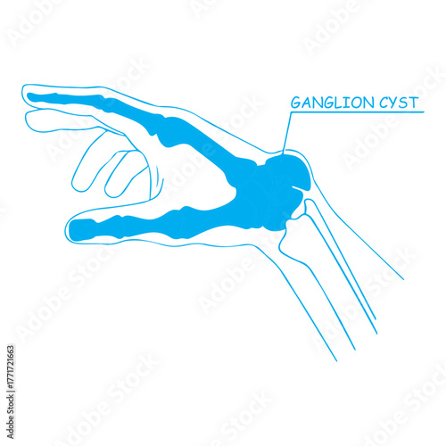 Ganglion Cyst