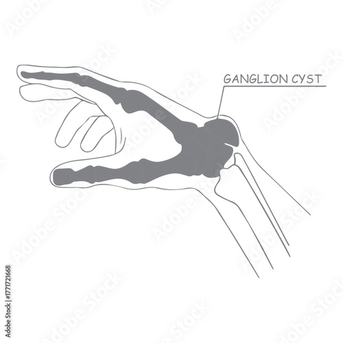 Ganglion Cyst Diagram