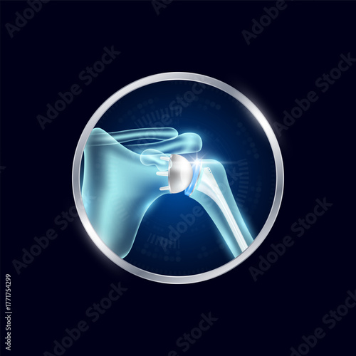 Artificial joints in circle frame label aluminum. Shoulder replacement or Prosthetic implant. Orthopedic technology surgery for treatment arthritis damaged cartilage. Medical product vector.