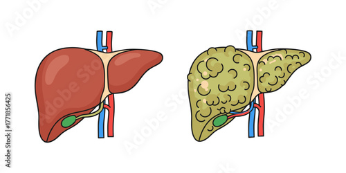 Comparing healthy and diseased liver illustrating cirrhosis condition